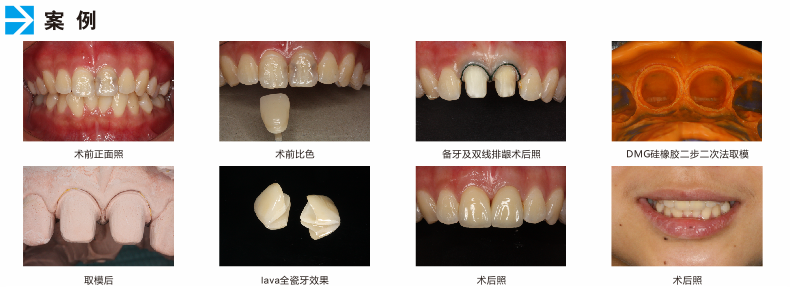 全瓷牙加工