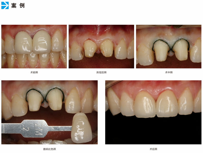 全瓷牙加工